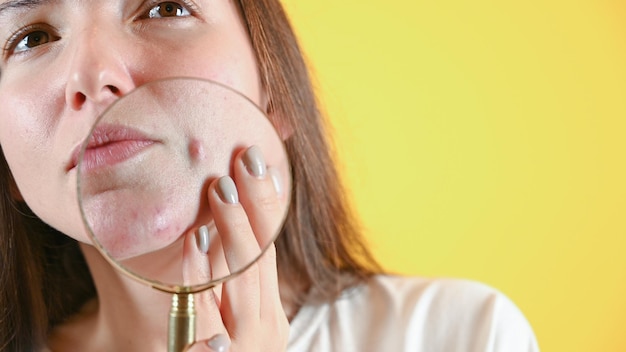 Vrouw met vergrootglas door gezicht bijgesneden weergave Close up van grote puistje Cosmetologie huidverzorging acne behandeling Hoge kwaliteit foto