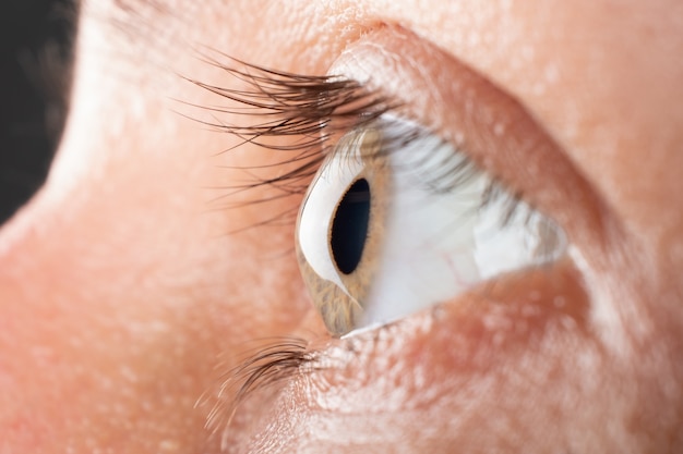 Foto vrouw oog close-up met 3 fase van keratoconus, corneadystrofie.