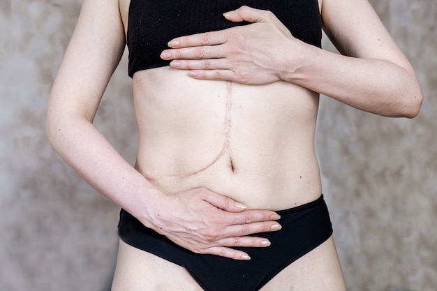Vrouw zonder gezicht in zwarte lingerie vertoont litteken op haar buik na leverdonatie
