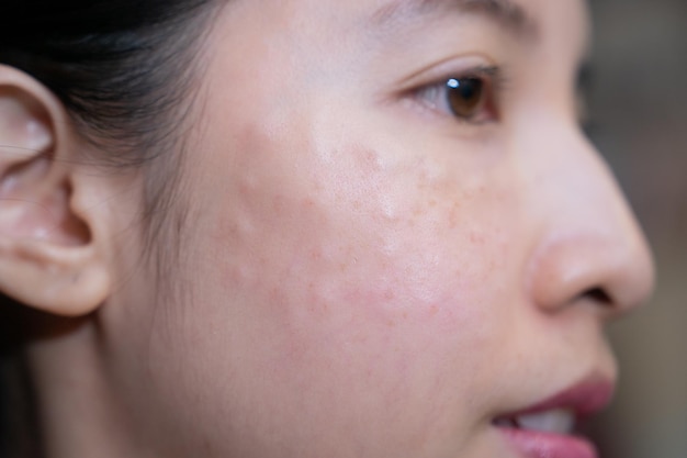 Vrouwelijk gezicht met stippen gezichtsvlekken na schoonheidsinjecties Verjongingsprocedure schoonheidsspecialiste mesotherapie patroon huidverzorging