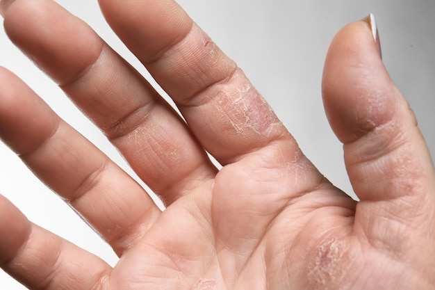 Vrouwelijke hand met dermatitis, close-up