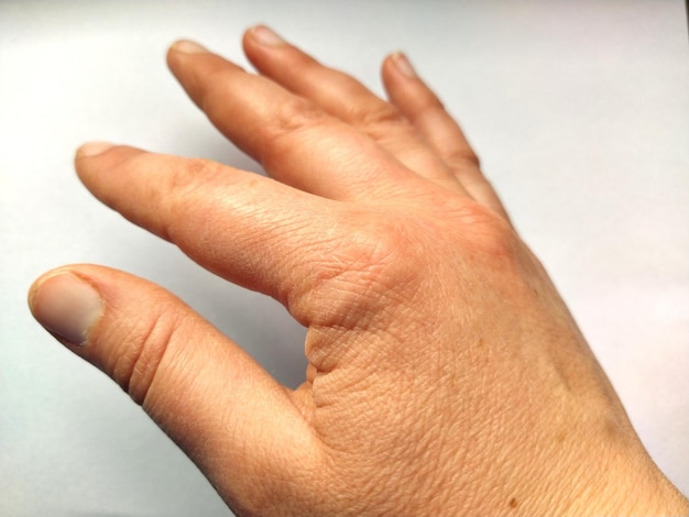 Vrouwelijke hand met droge atopische huid en pijnlijke gewrichten Witte achtergrond Close-up van de huid Pijn in de gewrichten van de hand en hand Degeneratieve ziekten of verwondingen Artralgie reumatoïde artritis