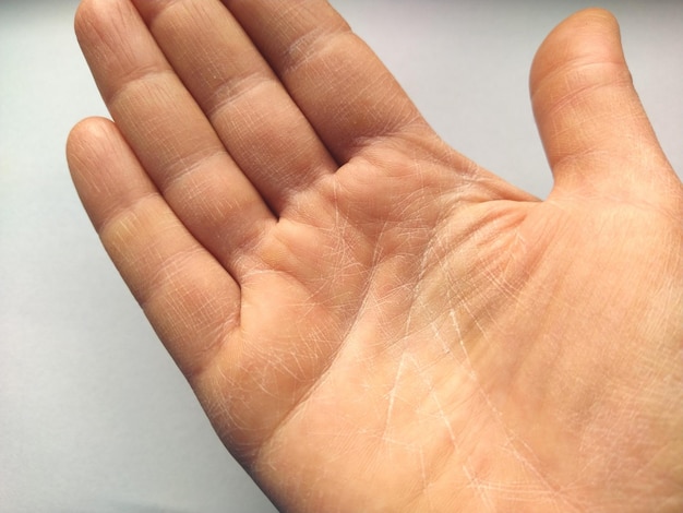 Vrouwelijke hand met droge atopische huid Witte achtergrond Close-up van de huid op de handpalm en vingers Derma die verzorging en hydratatie nodig heeft Rimpels, droogheid en irritatie op de handpalmlijnen