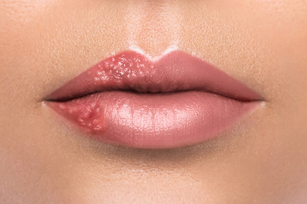 Vrouwelijke lippen aangetast door herpesvirus