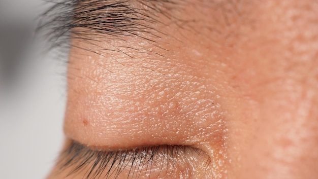 Wart on face. Macro shot of wart near eye. Papilloma on skin around eye nose and neck. Close up of birthmark Papilla or mole on skin. small hard. benign growth on the skin. caused by virus. skincare.