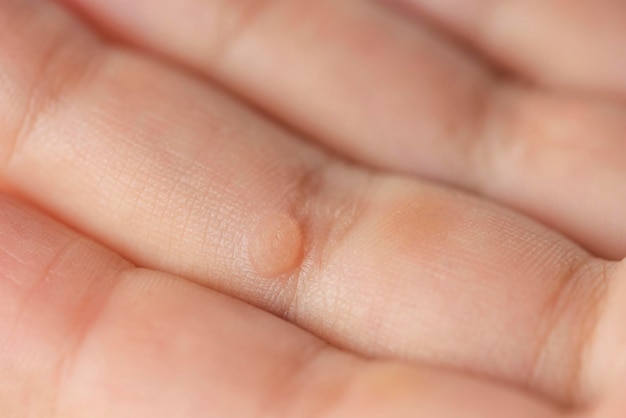 Wart on the finger closeup of a wart on a child\'s finger the\
common wart verruca vulgaris is caused by a type of human\
papillomavirus hpv