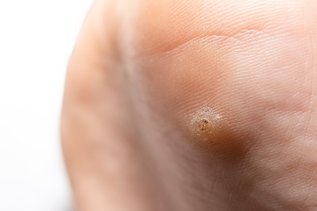 Wart, papilloma on a feet. Macro shot, selective focus, close-up, space for text. Dermatological problems with the skin.