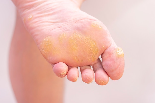 Warts and corns on foot.