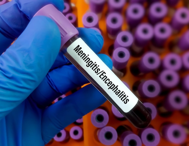 Wetenschapper met bloedmonster voor meningitis of encefalitis PCR-test