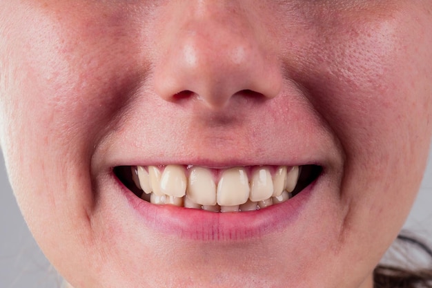 White smile with curvature tooth of young woman on whitw\
background in studio treatment braces system in the office of the\
orthodontist