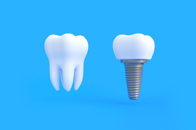 사진 파란색 배경 3d 렌더링 그림에 흰색 치아와 치과 임플란트
