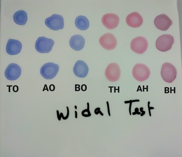 Foto widal-test geïsoleerd op een testplaat voor de diagnose van buiktyfus