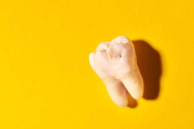 Wisdom tooth with tooth decay, yellow background. Removed third molar affected by caries. Dental extractions.