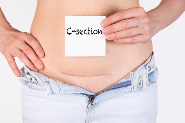 Woman belly with scar and caesarean section text on white sticker