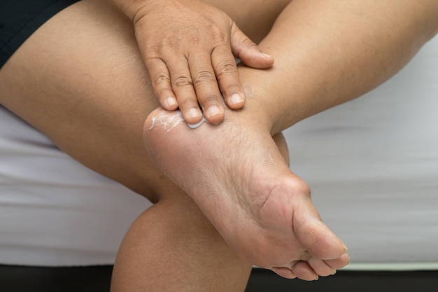 Woman care feet with cracked and dry heel skin cream at home