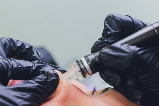 Woman cleaning nose skin pores using vacuum blackhead remover, cosmetic procedure.