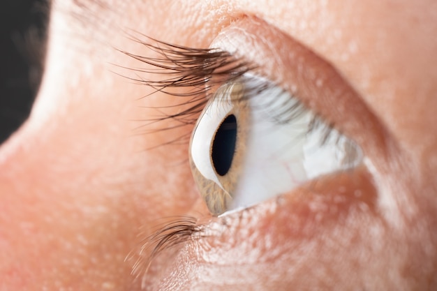 Крупный план глаза женщины с 3 стадией кератоконуса, дистрофии роговицы.