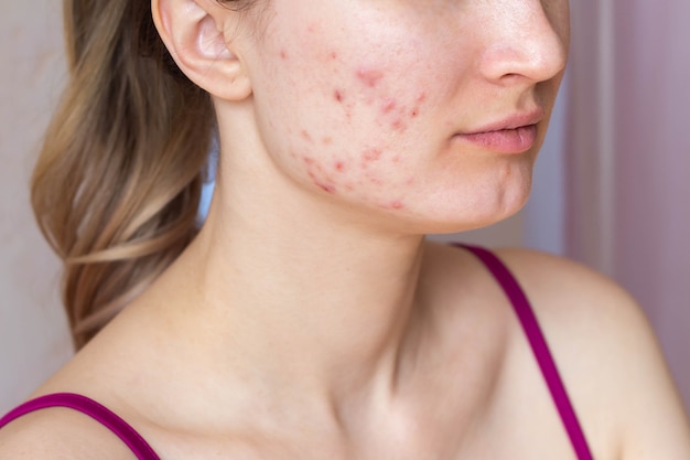 Woman face the problem of acne