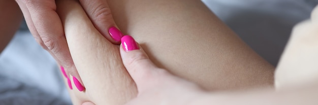 Woman hand holding fat fold with cellulite on thigh closeup