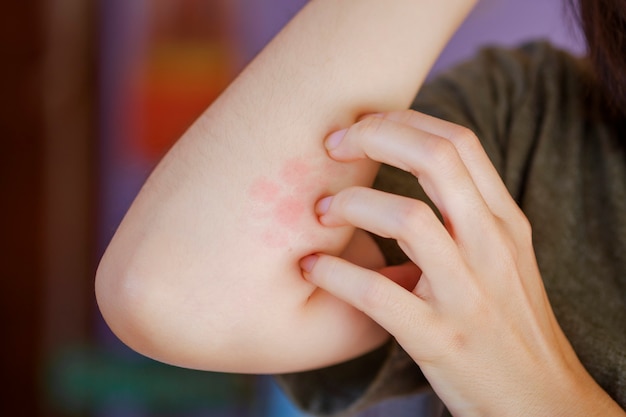 Photo a woman is scratching a red blistered arm due to a foreign body intolerance or an insect bite.