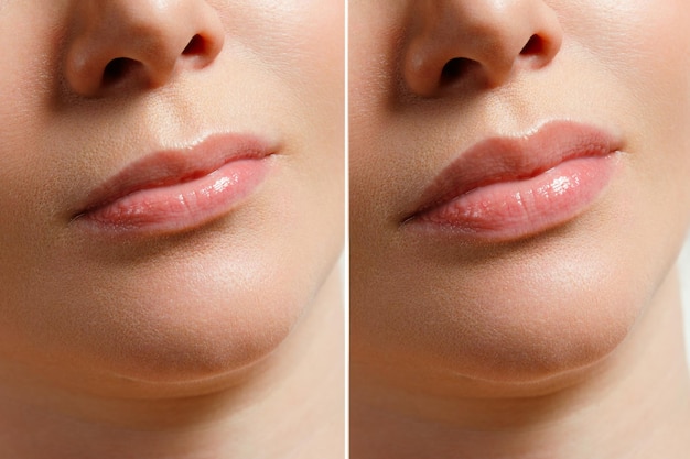 A woman makes lip shape correction in a cosmetology clinic lips injections lip augmentation