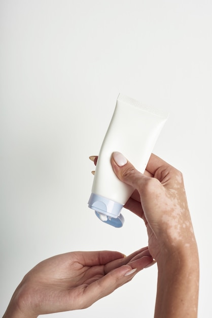 Woman pouring body care cream from bottle into her hand with vitiligo.