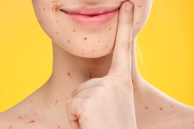 Woman rash and inflammation of the face, acne and
chickenpox