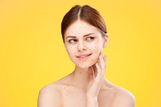 Woman rash and inflammation of the face, acne and
chickenpox