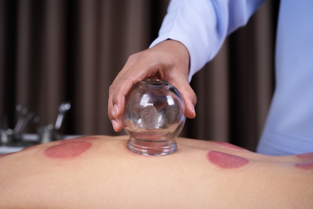 Woman receiving cupping treatment on back