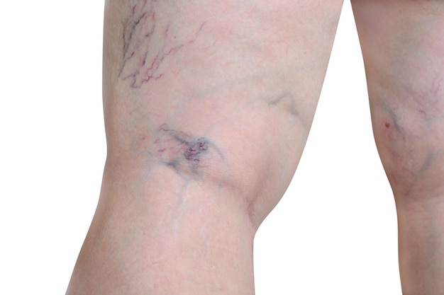 Woman reveals legs with varicose veins on legs varicose veins on legs