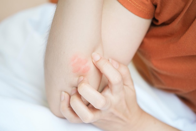 The woman's arms were itchy and red due to insect bites