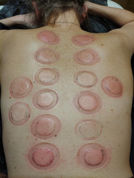 A woman's back in round red spots from treatment with nontraditional medical methods