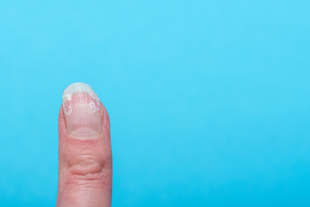 Foto dito della donna con unghie morse e rotte senza manicure con cuticola troppo cresciuta e lamina ungueale danneggiata