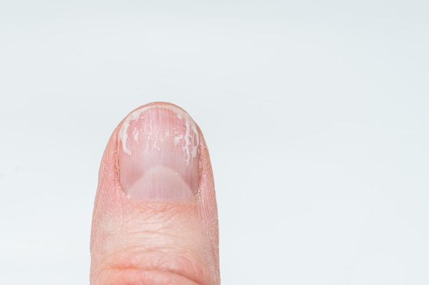 Nail Pitting: Causes, Treatment, and More