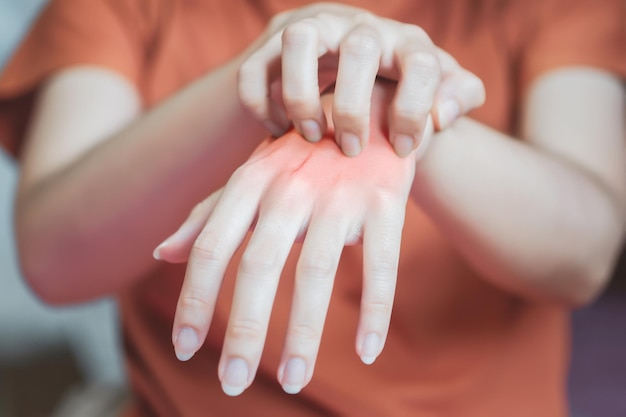 여자의 손에는 붉은 발진과 가려움증이 있어서 어떤 물질에 대한 알레르기 때문에 긁었습니다.