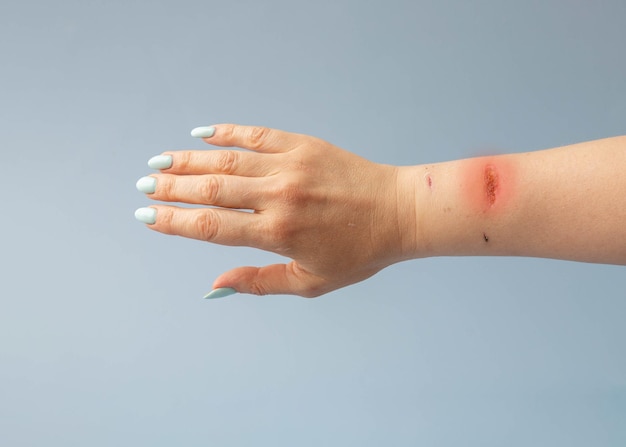 파란색 매니큐어가 있는 여성의 손과 손목에 큰 상처