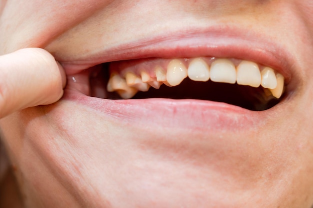 Woman's teeth before prosthetics Full mouth