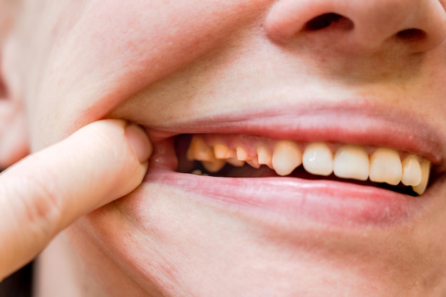 Woman's teeth before prosthetics Full mouth