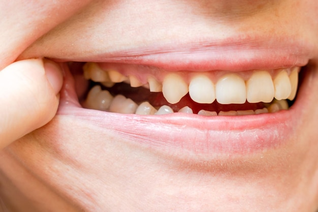 Зубы женщины до протезирования Полный рот