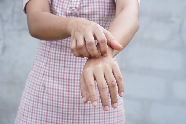 Woman scratching arm from itching 
