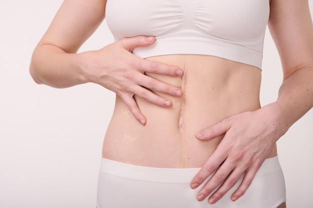 Woman showing her scar on belly