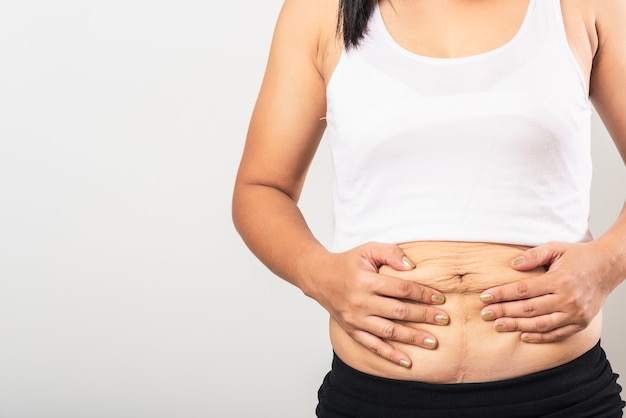 Woman showing stretch mark on abdomen