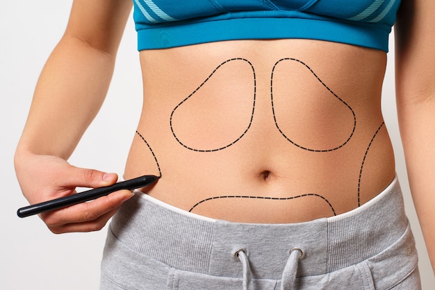 A woman shows a dotted line on her body liposuction zone