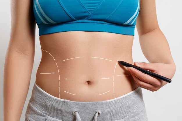 A woman shows a dotted line on her body liposuction zone