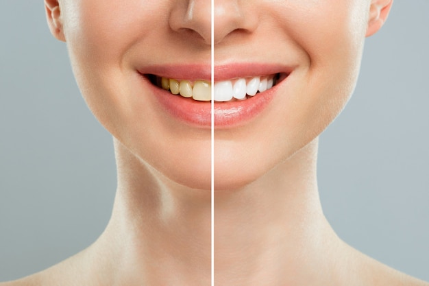 Photo woman teeth before and after whitening. over white background. dental clinic patient. image symbolizes oral care dentistry, stomatology.