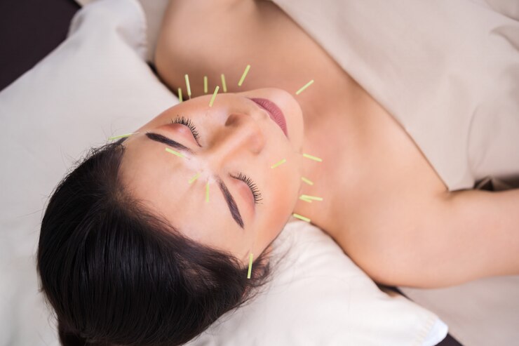 顔に鍼治療を受けている女性