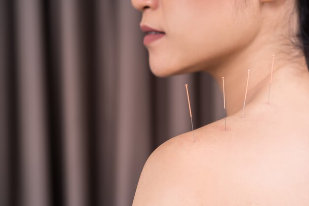 Photo woman undergoing acupuncture treatment on shoulder