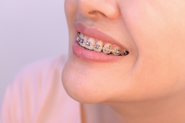 Woman wearing orthodontic retainer. Dental care and healthy teeth.