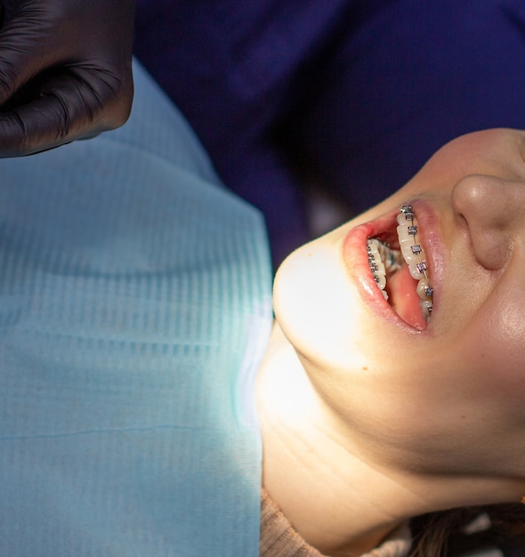 A woman with braces on her teeth visits an orthodontist, in a dental chair. during the procedure of installing the arch of braces on the upper and lower teeth. The girl smiles.The concept of dentistry