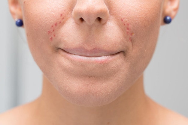 Woman with dermal problems caused by irritation of the mask